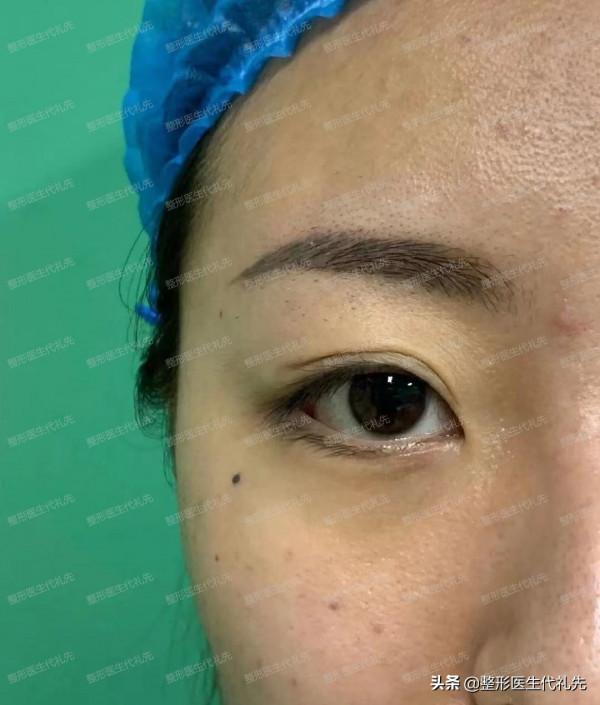 40歲剛做了眼綜合,和姐妹們分享一下我的親身經歷和感受 40歲剛做了眼綜合,和姐妹們分享一下我的親身經歷和感受