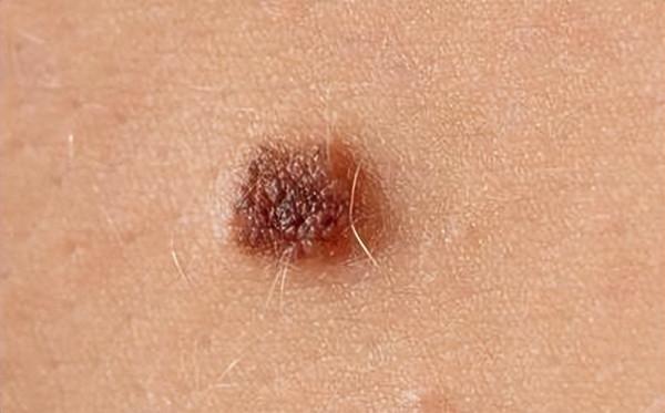 醫生提醒：若黑痣長在這4個部位，要密切關注，及早做檢查