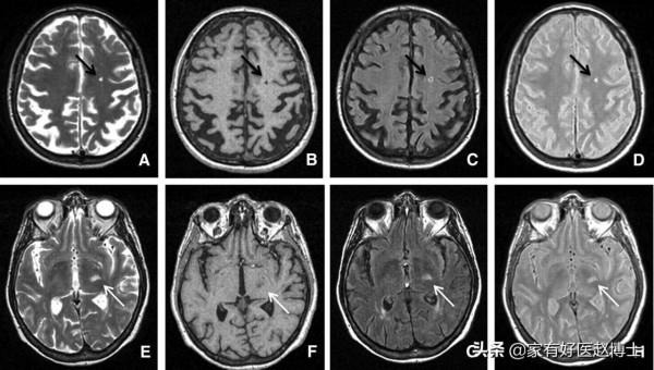 “血管老化”的五大常見徵象,您有嗎?及時干預,哪些藥物可選? “血管老化”的五大常見徵象,您有嗎?及時干預,哪些藥物可選?