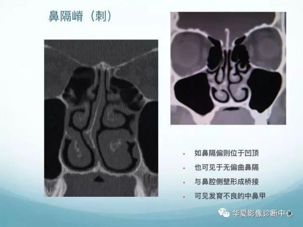 頭頸五官CT斷層解剖圖及常見病影像診斷