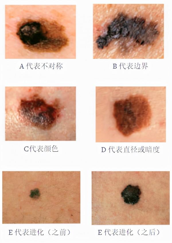 美國27歲網紅去世…18歲出現黑痣沒管,三年後:癌症晚期 美國27歲網紅去世…18歲出現黑痣沒管,三年後:癌症晚期