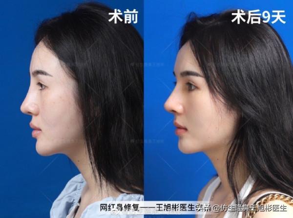 隆鼻就能提升面部立體感?不,有效和無效手術,關鍵在於它 隆鼻就能提升面部立體感?不,有效和無效手術,關鍵在於它