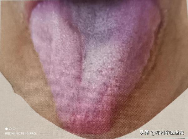 胃痛、脾胃虛寒的舌象