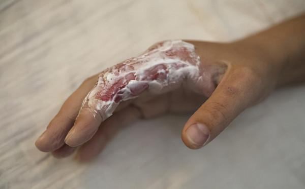 紅黴素軟膏幾個作用不妨瞭解,作為常備藥膏,這幾種情況儘量別用 紅黴素軟膏幾個作用不妨瞭解,作為常備藥膏,這幾種情況儘量別用