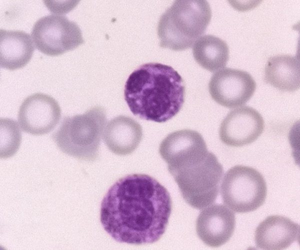 一例慢性中性粒細胞白血病病例分享