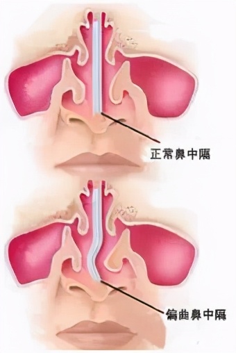 鼻塞、噴嚏不斷就是鼻炎?NO!有可能是鼻中隔偏曲惹的禍 鼻塞、噴嚏不斷就是鼻炎?NO!有可能是鼻中隔偏曲惹的禍