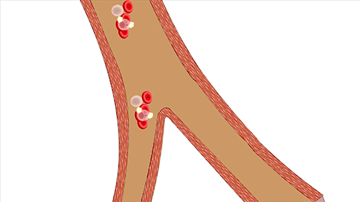 秋風蕭瑟,當心腦出血 秋風蕭瑟,當心腦出血