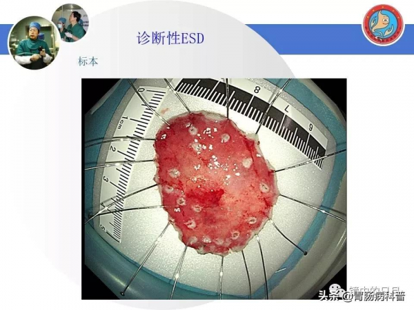 早期胃癌——內鏡診治流程