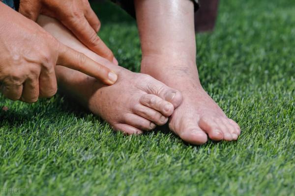 老年人小腿和腳背浮腫是怎麼回事?警惕4種原因,教你改善絕招 老年人小腿和腳背浮腫是怎麼回事?警惕4種原因,教你改善絕招