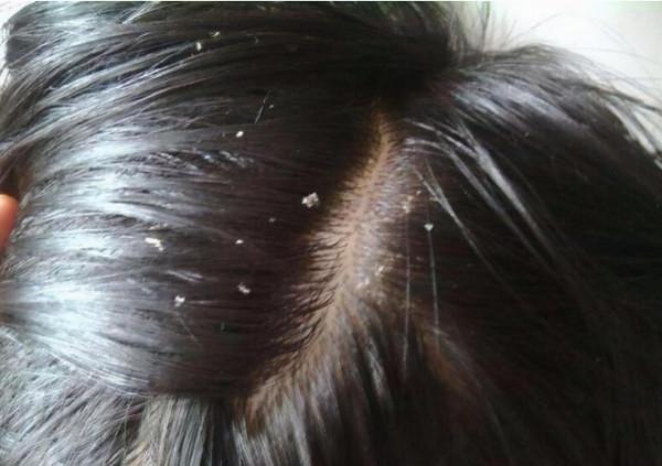 為什麼頭皮總長“疙瘩”和“膿包”？或許跟這4個因素有關