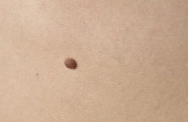 為何有些人脖子後邊都有一顆“痣”？是好是壞？原來並不是巧合