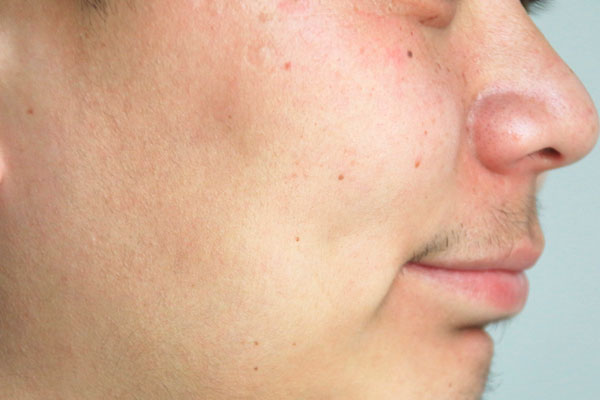 老年斑的誘發因素有哪些？為什麼有的人老了以後，不長老年斑？