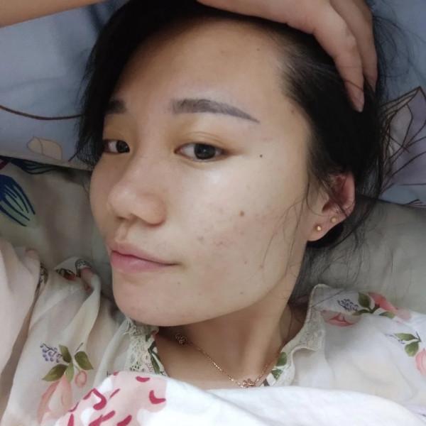 怎樣祛痘和痘印？教你四個小妙招，簡單又實用