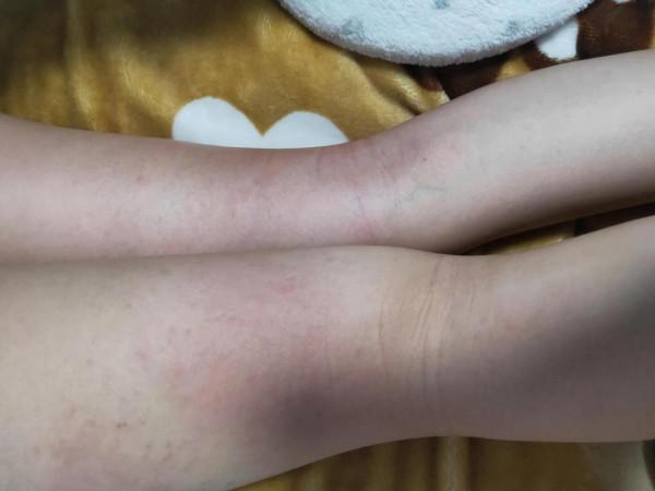 6歲寶寶接種新冠疫苗後