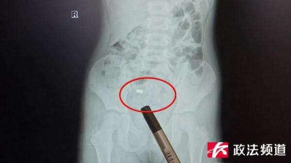 湖南6歲女童誤吞磁珠，家長以為能自行排出，十天後女童腸道已糜爛