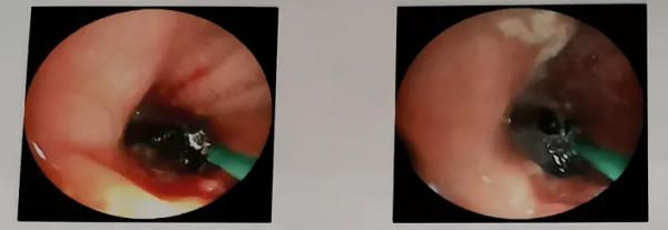 咳嗽一年找不到原因，原來是鈣化惹的禍