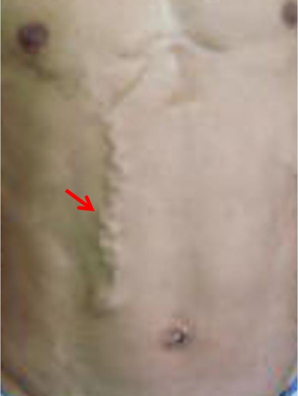 “青筋凸起”是因血管毒素淤積？小心這些部位的凸起，或是疾病