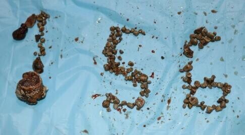 印度一名50歲教師突感腹痛 醫生從其體內取出156顆腎結石