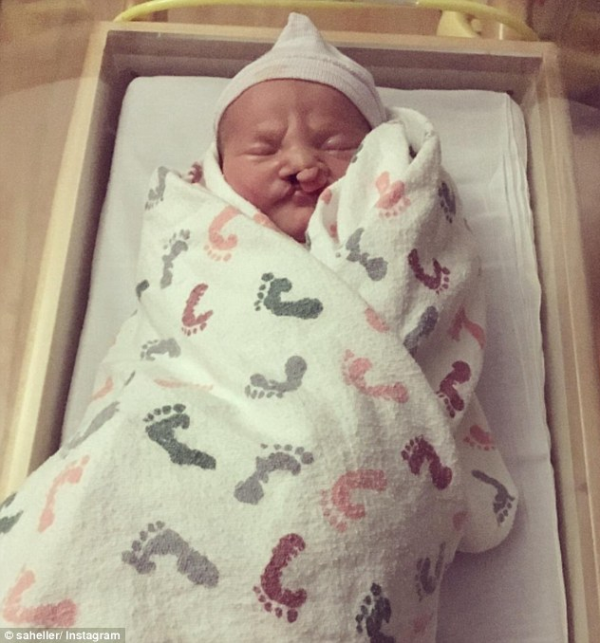 父母不顧醫生建議拒絕墮胎，重度唇顎裂的寶寶現在長成美男了