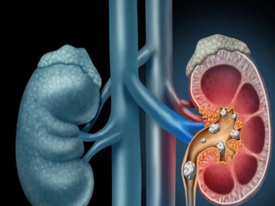 尿毒症腎衰竭為何越來越多？避開傷腎的5個誤區，很重要