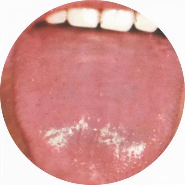 舌苔你會看嗎？舌苔反映著我們的健康，也是中醫辯證常用手段