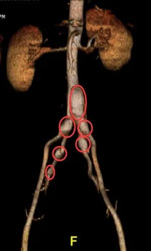 41歲男子體內隱藏一連串動脈瘤，醫生自制“拆雷工具”排險
