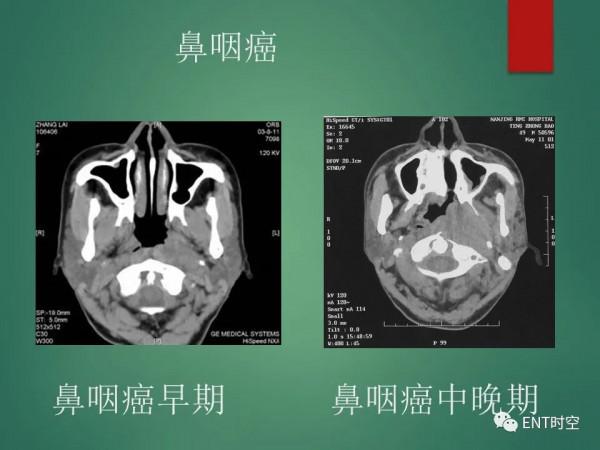 頭頸五官CT斷層解剖圖及常見病影像診斷