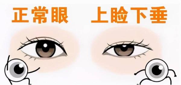 上瞼提肌是什麼？上眼瞼肌無力怎麼辦？