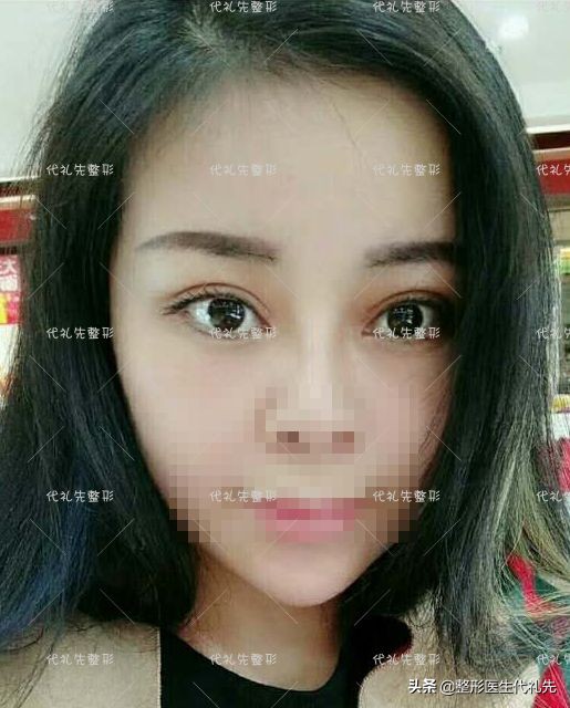 45歲姐姐做了平行雙眼皮+微創小切口提升，又重新回到了35歲
