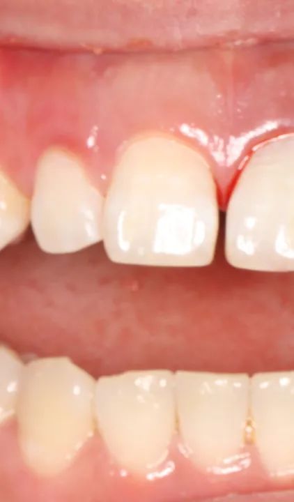 同仁醫線丨精準種植，美學修復，再也不用愁眉苦臉了