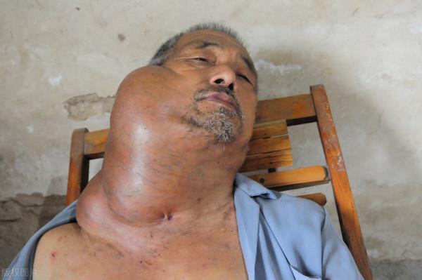 “怪病都因痰作祟”,淺說治痰心得 “怪病都因痰作祟”,淺說治痰心得