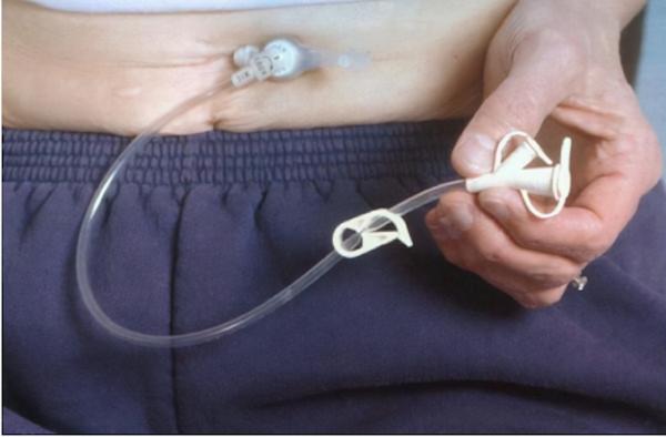 連體兒分離手術難度有多高？江西女嬰臀部相連，唯一的肛門咋分？