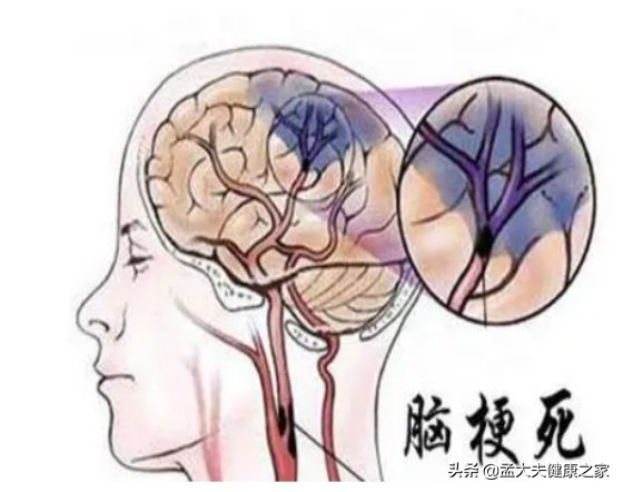 老年人預防腦梗與老年痴呆，如何補充葉酸與B12很重要，請看此文