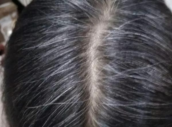 為什麼白頭髮越長越多？你以為是老了，醫生：或是缺乏2種營養素