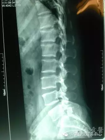 骶椎腰化/腰椎骶化、腰椎滑脫、腰肌勞損，簡單易懂圖解