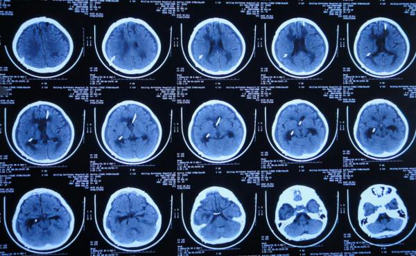 顱內生殖細胞瘤切除術後腦積水仍反覆,意識模糊,左側肢體偏癱 顱內生殖細胞瘤切除術後腦積水仍反覆,意識模糊,左側肢體偏癱