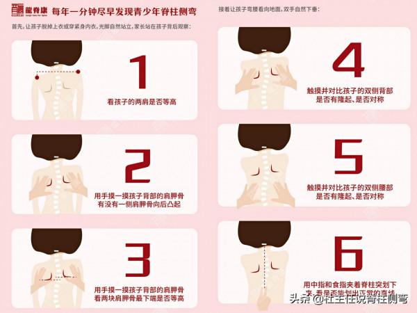 病例分享:62°脊柱側彎孩子兩年治療經歷 病例分享:62°脊柱側彎孩子兩年治療經歷