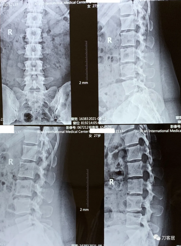 27歲女性，兩間隙腰椎間盤突出症，6顆釘子，4個融合器