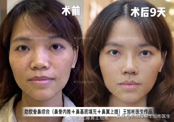 鼻頭縮小可以只“減脂”，不取自體軟骨做支架嗎？