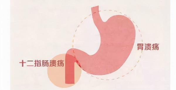 胃口太好了容易得糖尿病、潰瘍等疾病