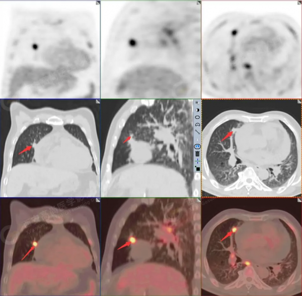 肺結節看診（13）：肺小結節全身廣泛轉移2例，PET分期：晚期