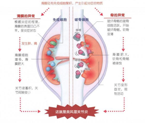 金子做成藥可治療類風溼關節炎,戴金首飾可以嗎? 金子做成藥可治療類風溼關節炎,戴金首飾可以嗎?