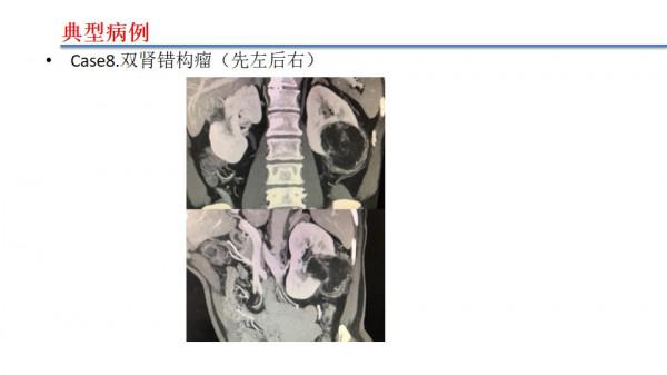 南昌大學二附院泌尿外科江偉凡博士分享腹腔鏡腎部分切除術治療複雜腎腫瘤的新進展及疑難病例