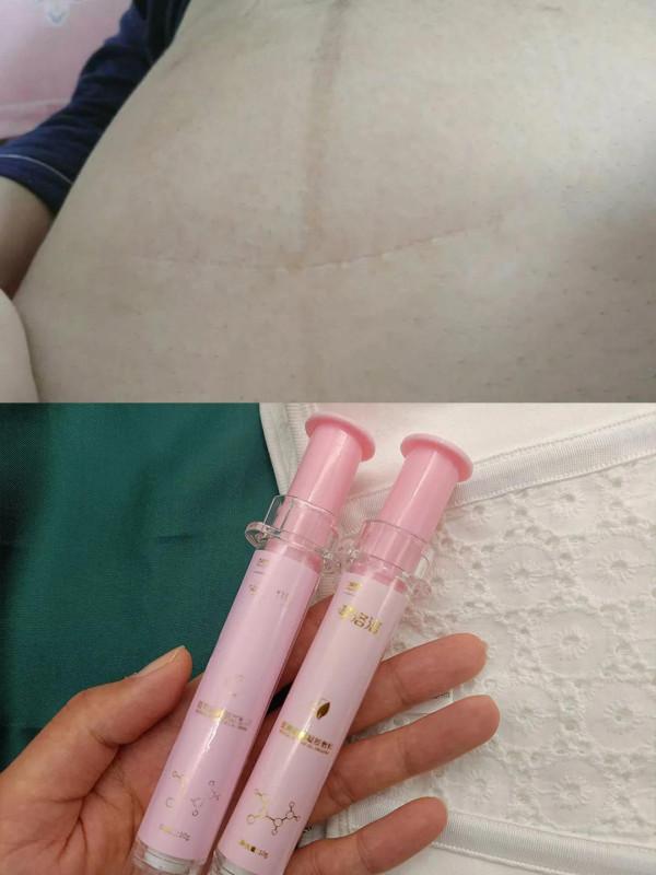 剖腹產一定需要收腹帶?說說我的感受 剖腹產一定需要收腹帶?說說我的感受