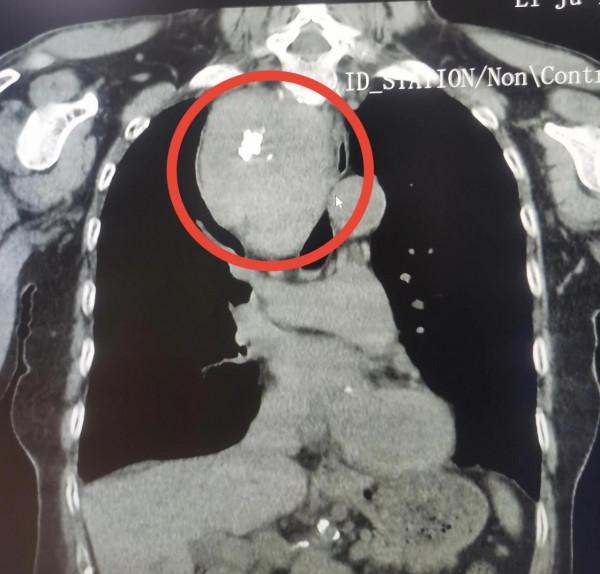 長了15年的頸部包塊消失了？婆婆體檢發現原是長入胸腔