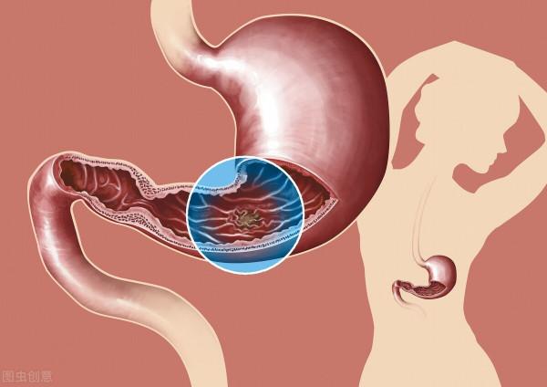 慢性胃炎反覆發作？醫生提醒養胃護胃，這4點缺一不可