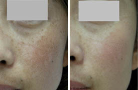 祛斑有什麼好的方法？