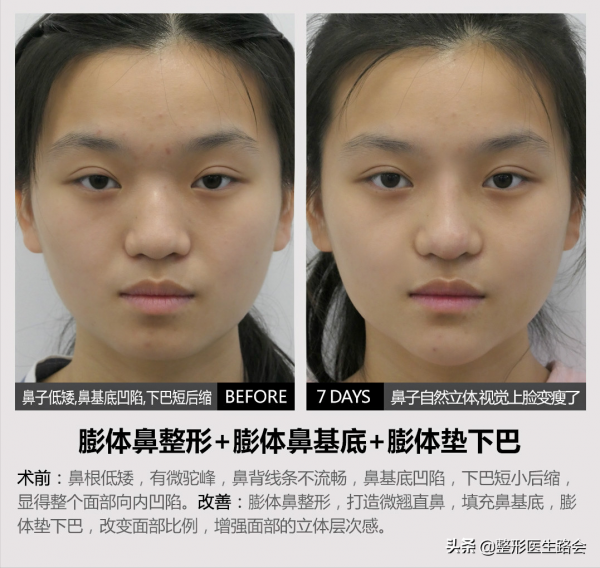 做假體隆鼻,整形醫生告訴你:術前、術中、術後,如何少走彎路 做假體隆鼻,整形醫生告訴你:術前、術中、術後,如何少走彎路