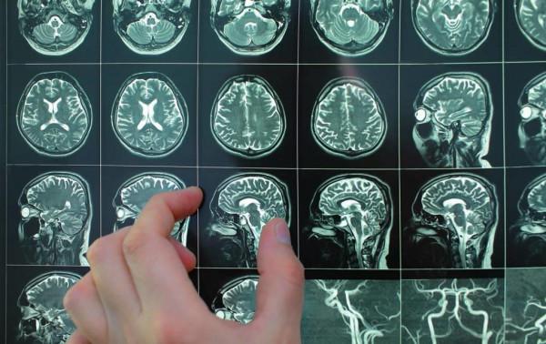 發現“腔梗”後怎麼辦？腔隙性腦梗，是什麼原因引的呢？