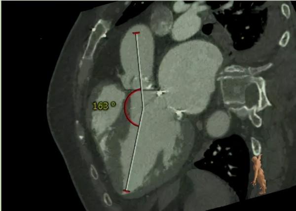 中秋假期,老人心臟生物瓣膜衰敗生命垂危,多學科團隊新技術成功巧換“心門” 中秋假期,老人心臟生物瓣膜衰敗生命垂危,多學科團隊新技術成功巧換“心門”